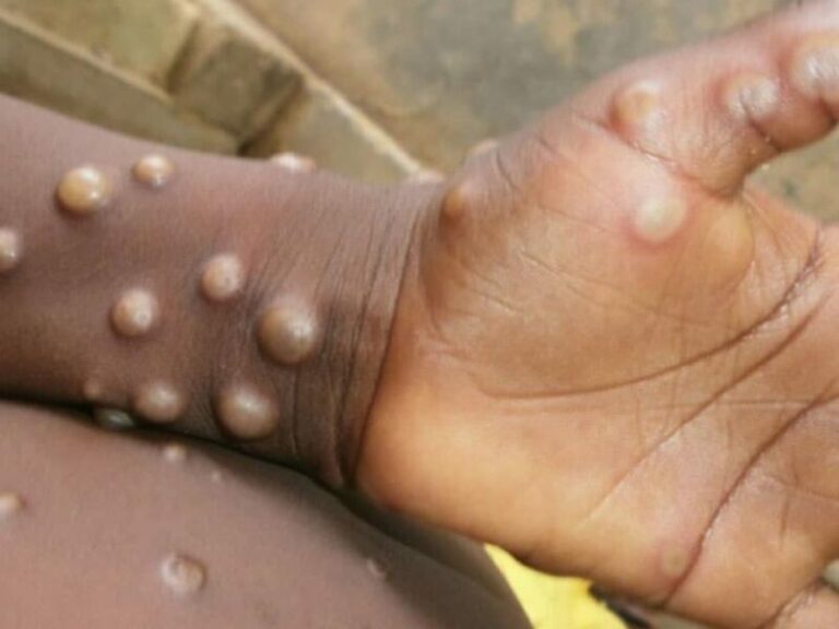 variole du singe « MONKEYPOX