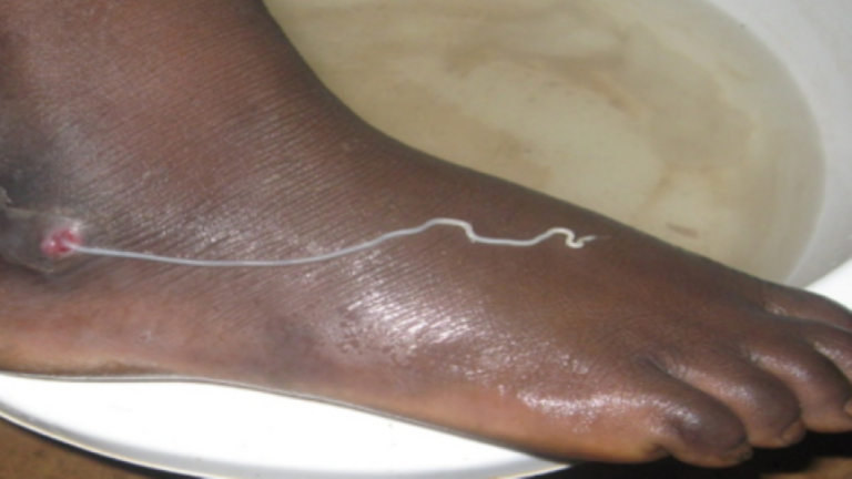 Profitant de cette tribune, elle réitère l’engagement du Mali à soutenir toutes actions allant dans le sens de l’atteinte de la déclaration d’Abu Dhabi de 2022 sur l’arrêt de la transmission du ver de Guinée d’ici 2026 et l’obtention de la certification du pays à l’horizon 2030 s’inspirant des différentes déclarations de l’OMS relatives à l’éradication de la dracunculose.